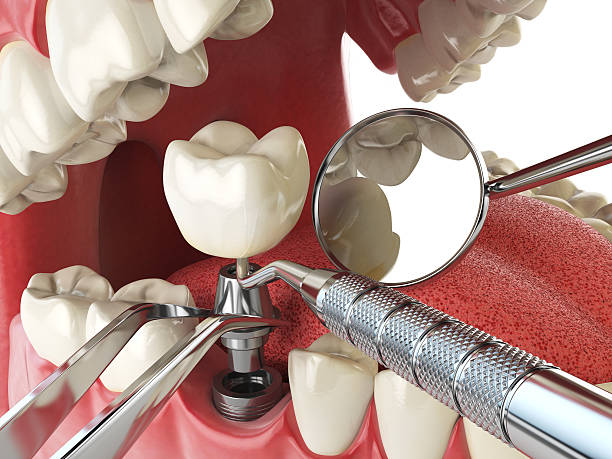 Best Emergency Dental Care for Broken or Chipped Teeth in North Gates, NY